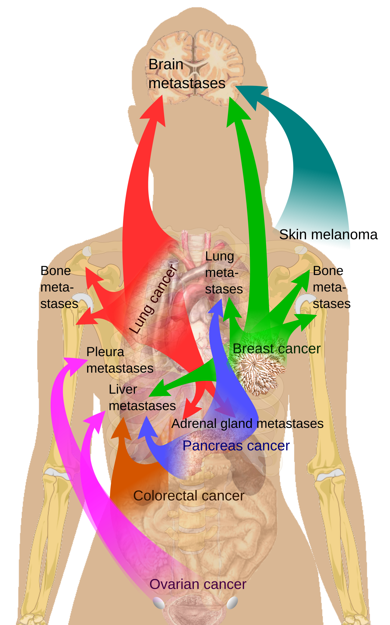 Main sites of metastases for common cancer types primary can