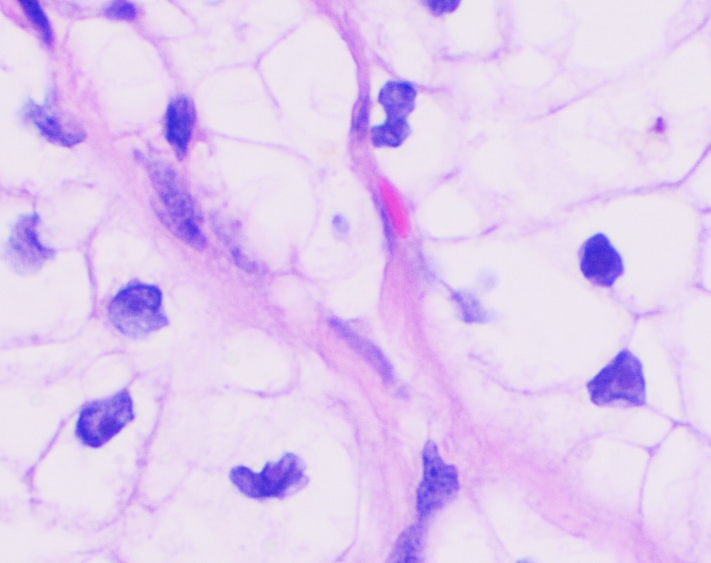 Grade 2 clear cell renal cell carcinoma showing clearly visi