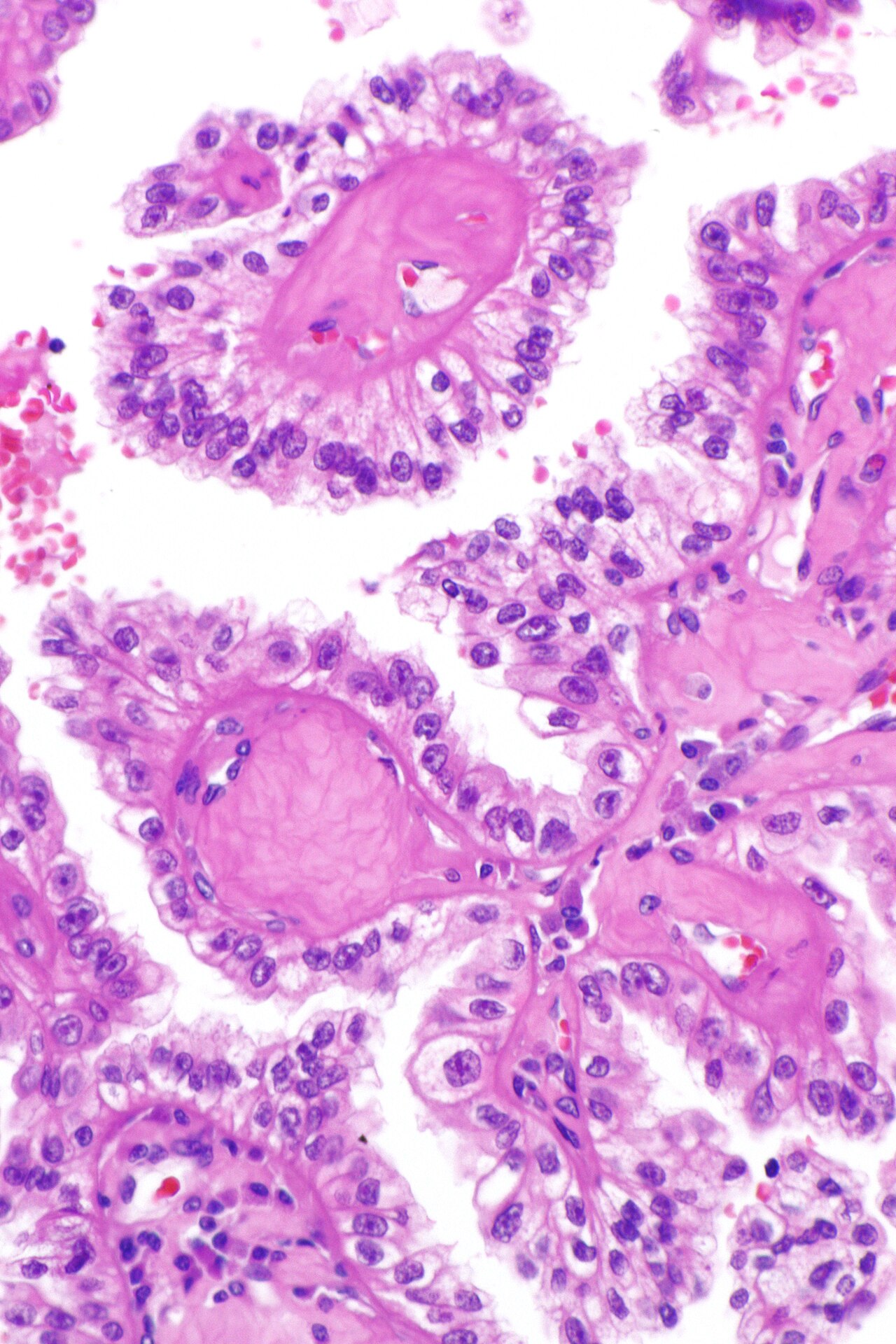 Micrograph of renal cell carcinoma in hereditary leiomyomato