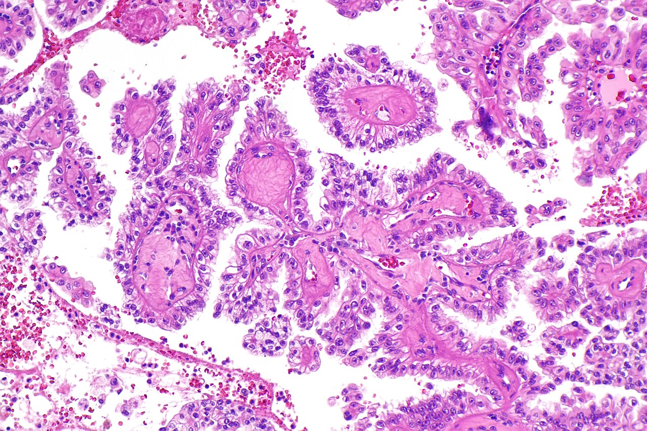 Micrograph of renal cell carcinoma in hereditary leiomyomato