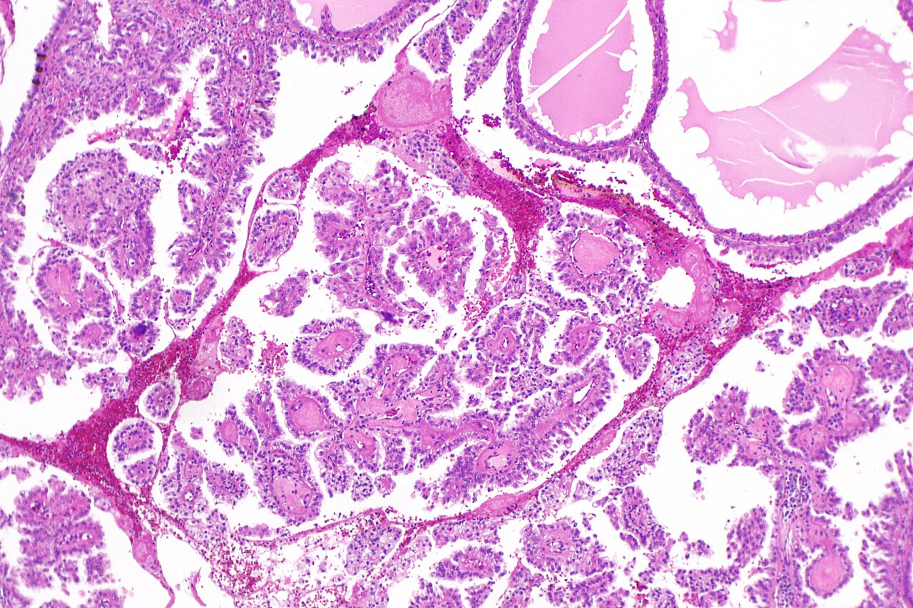 Micrograph of renal cell carcinoma in hereditary leiomyomato