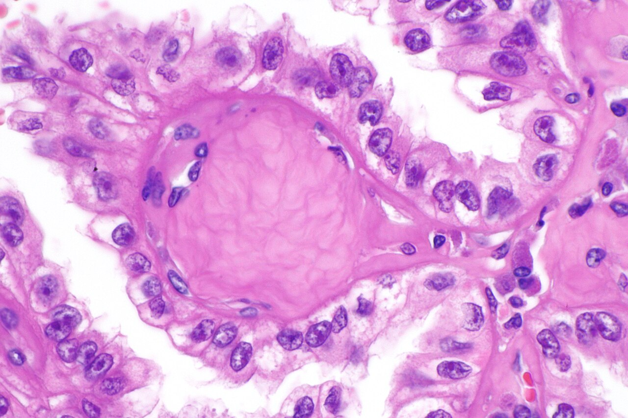 Micrograph of renal cell carcinoma in hereditary leiomyomato