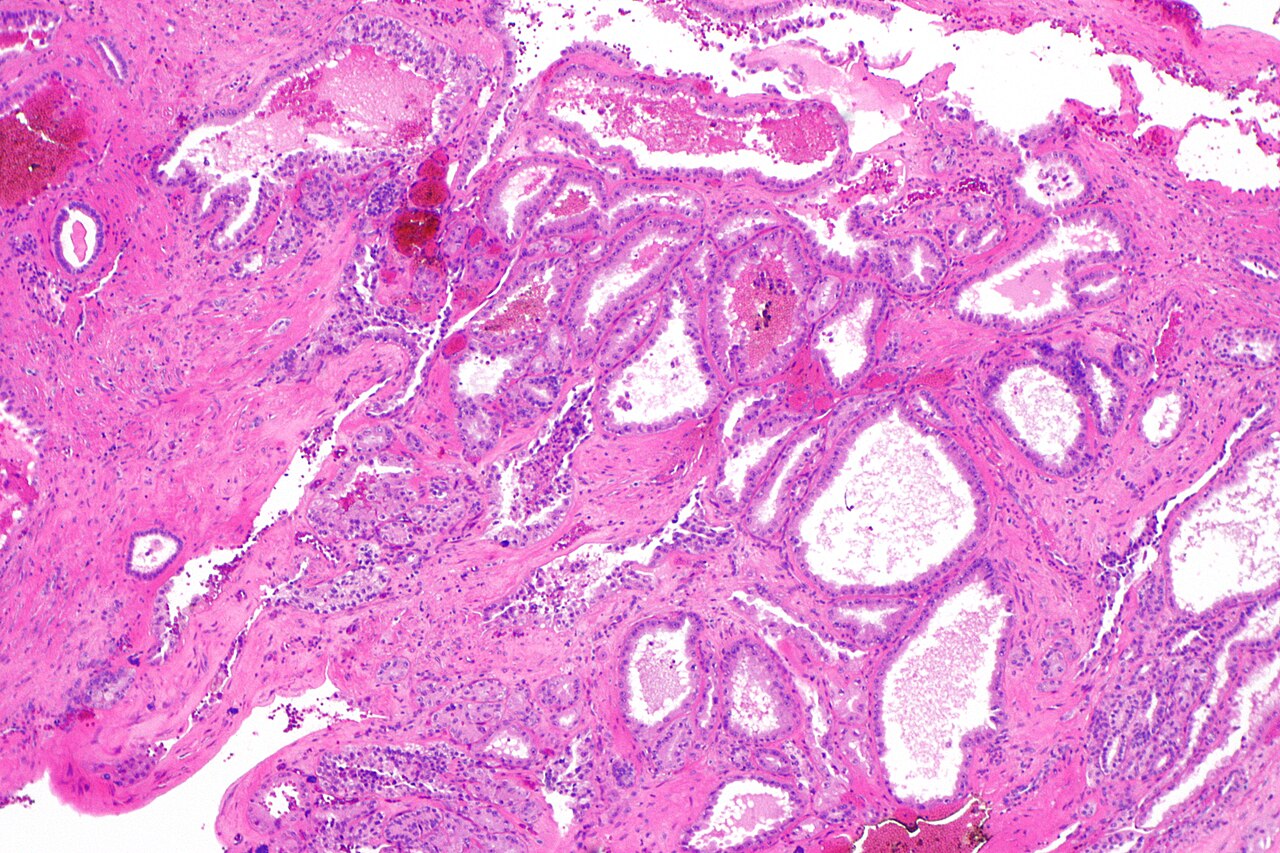 Micrograph of renal cell carcinoma in hereditary leiomyomato
