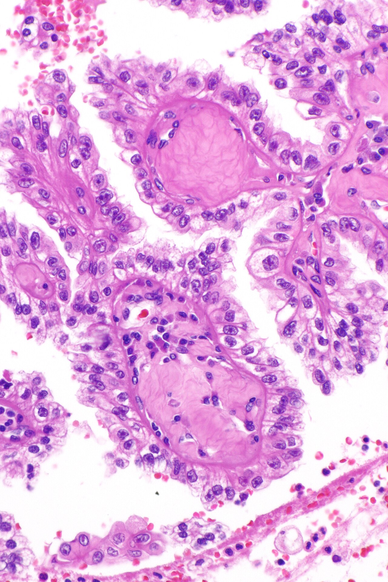Micrograph of renal cell carcinoma in hereditary leiomyomato