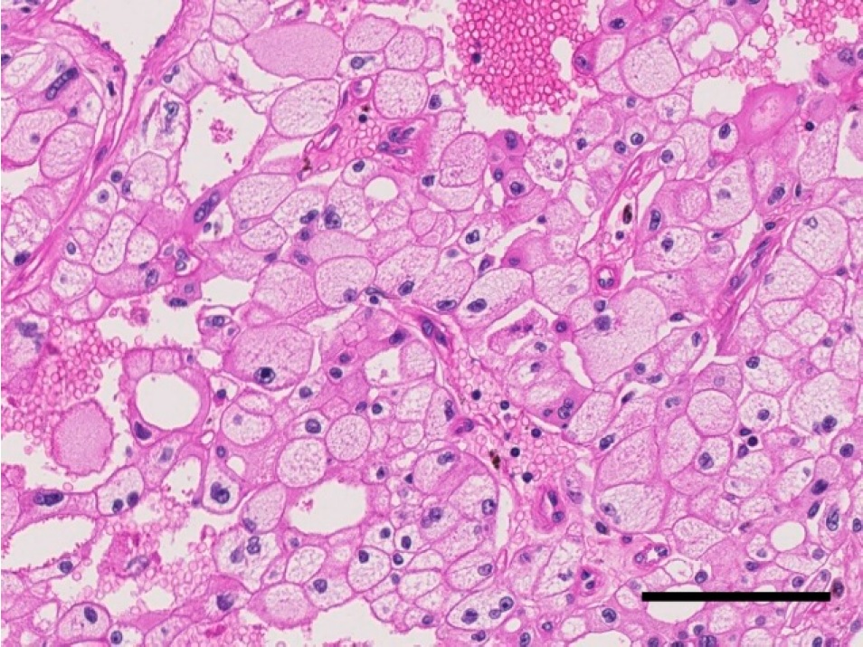 Histopathology of classic chromophobe renal cell carcinoma w