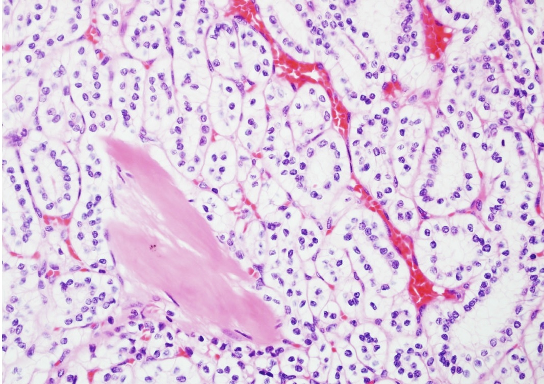 Histopathology of clear cell papillary renal cell carcinoma