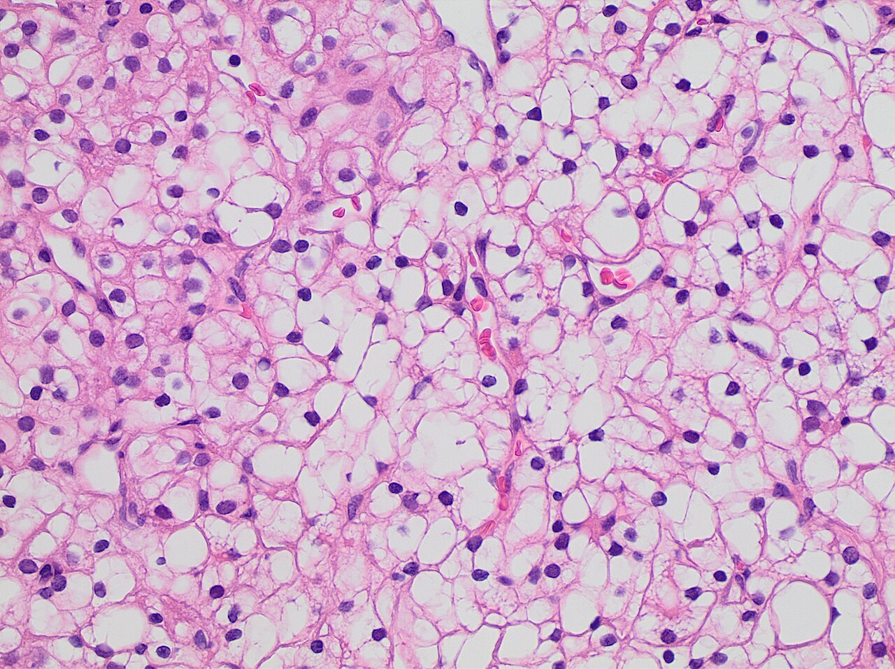Histopathology of clear cell renal cell carcinoma grade 1 in