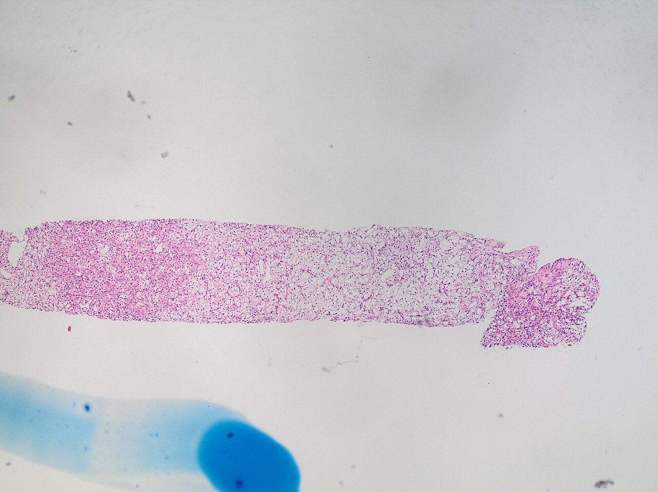 Histopathology of clear cell renal cell carcinoma grade 1 lo