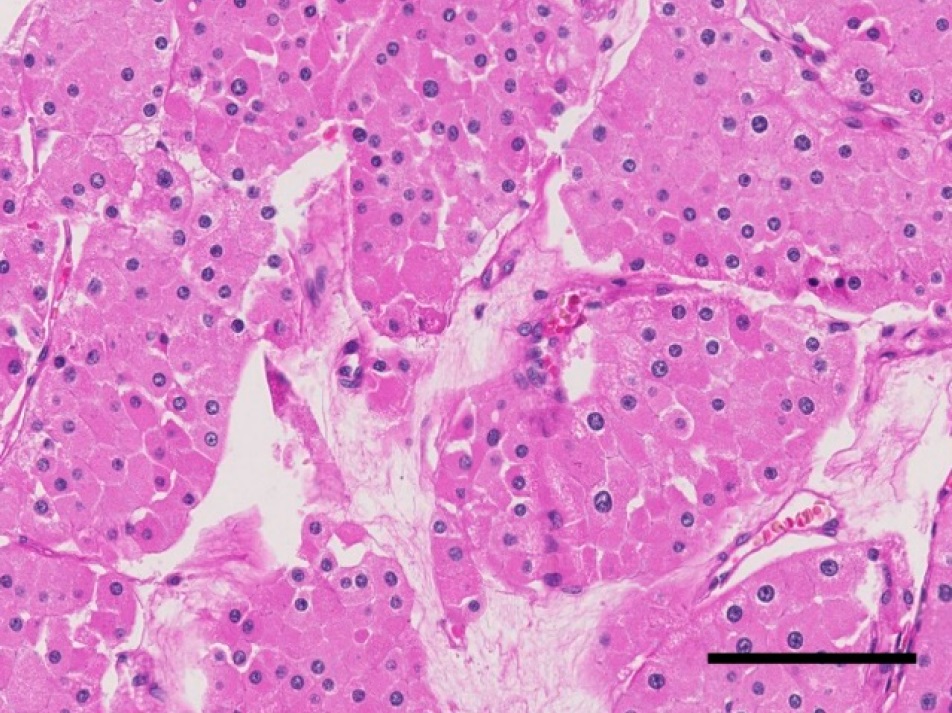Histopathology of eosinophilic chromophobe renal cell carcin
