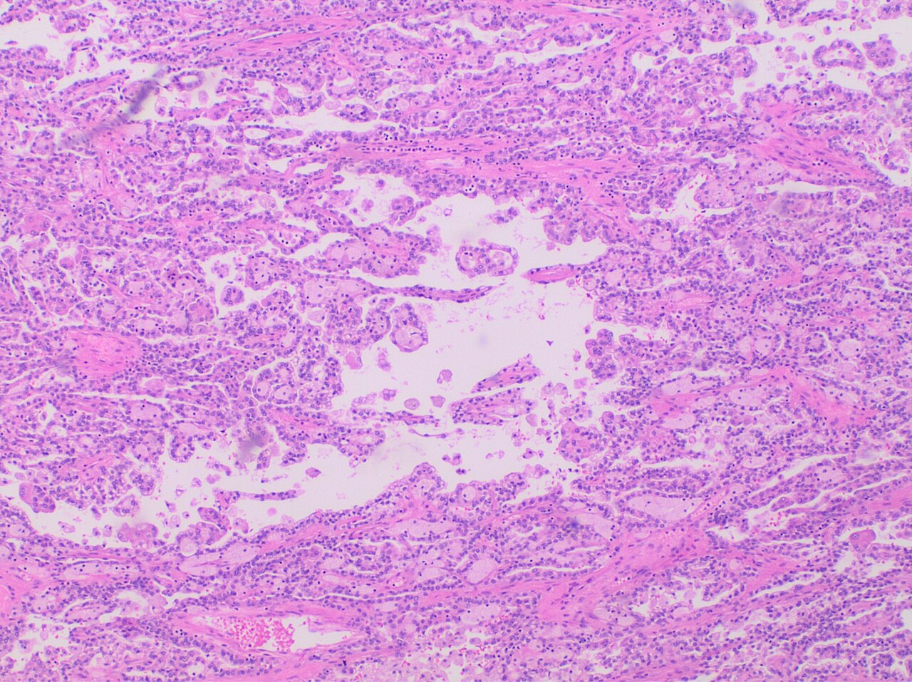 Histopathology of papillary renal cell carcinoma type 1 low