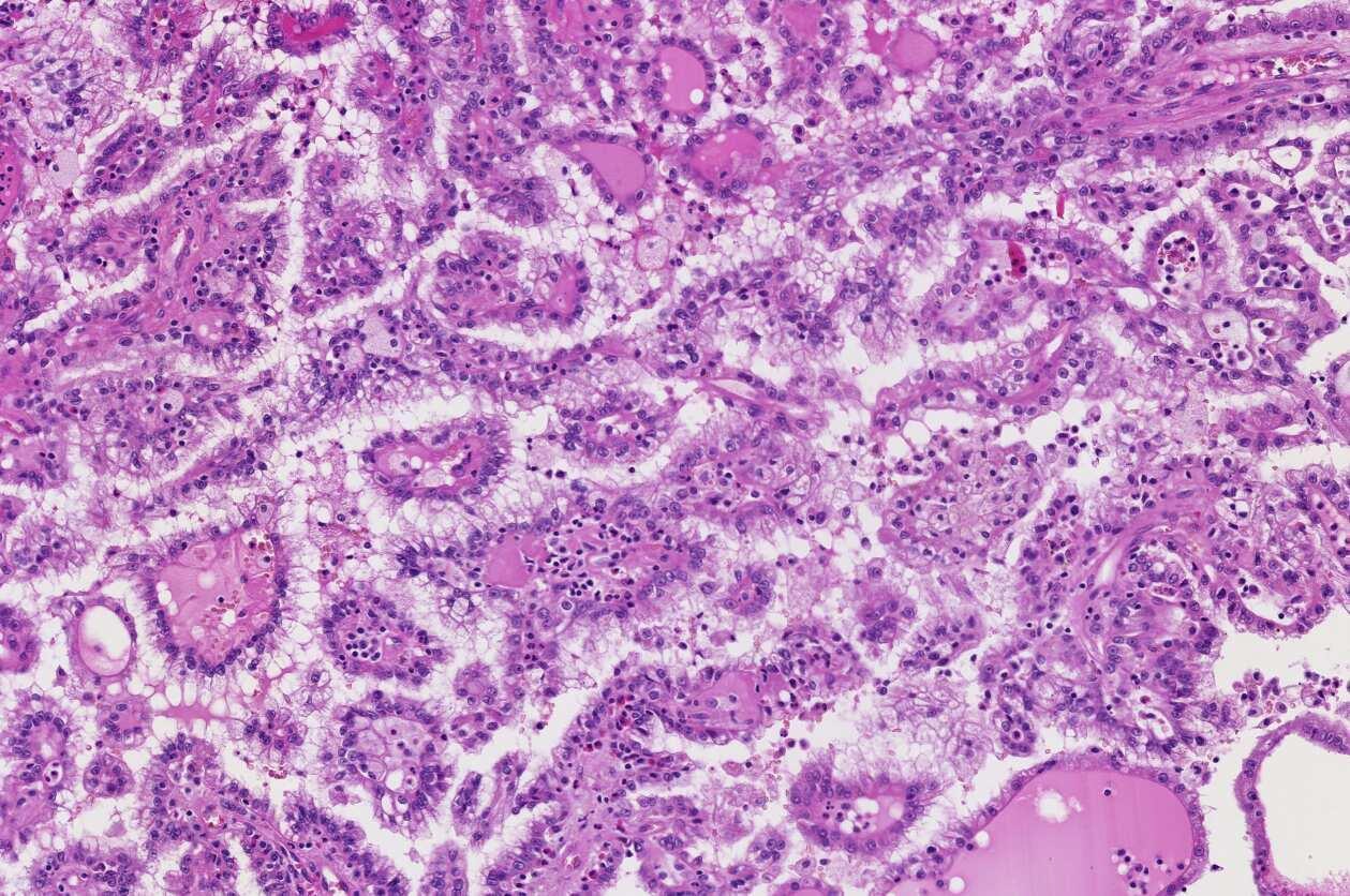 Histopathology of papillary renal cell carcinoma type 1 char