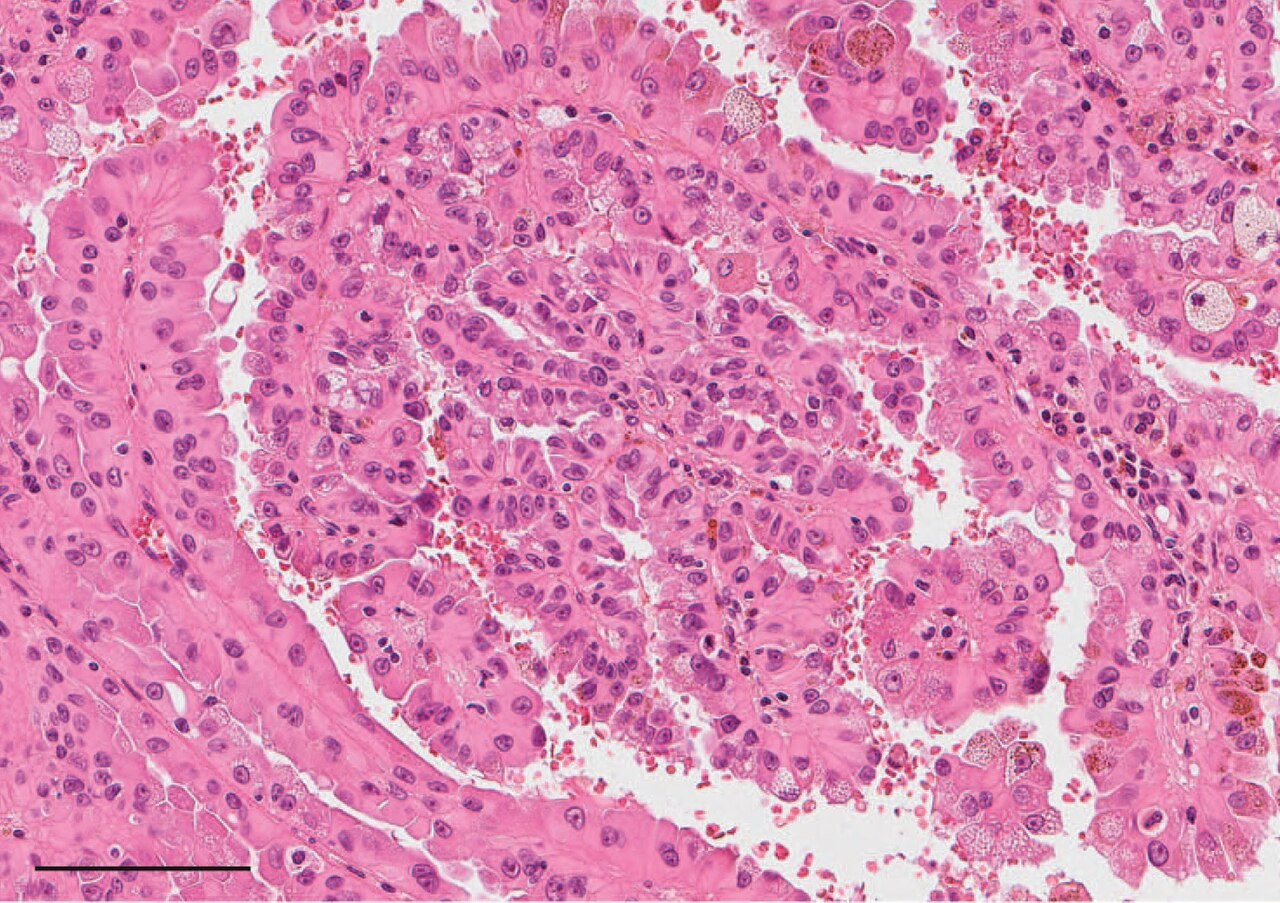 Histopathology of papillary renal cell carcinoma type 2