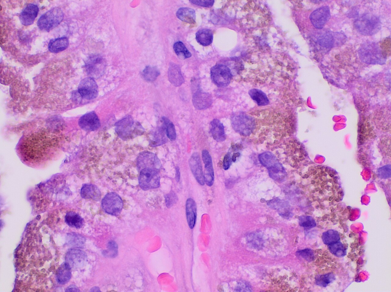 Histopathology of papillary renal cell carcinoma renal cell
