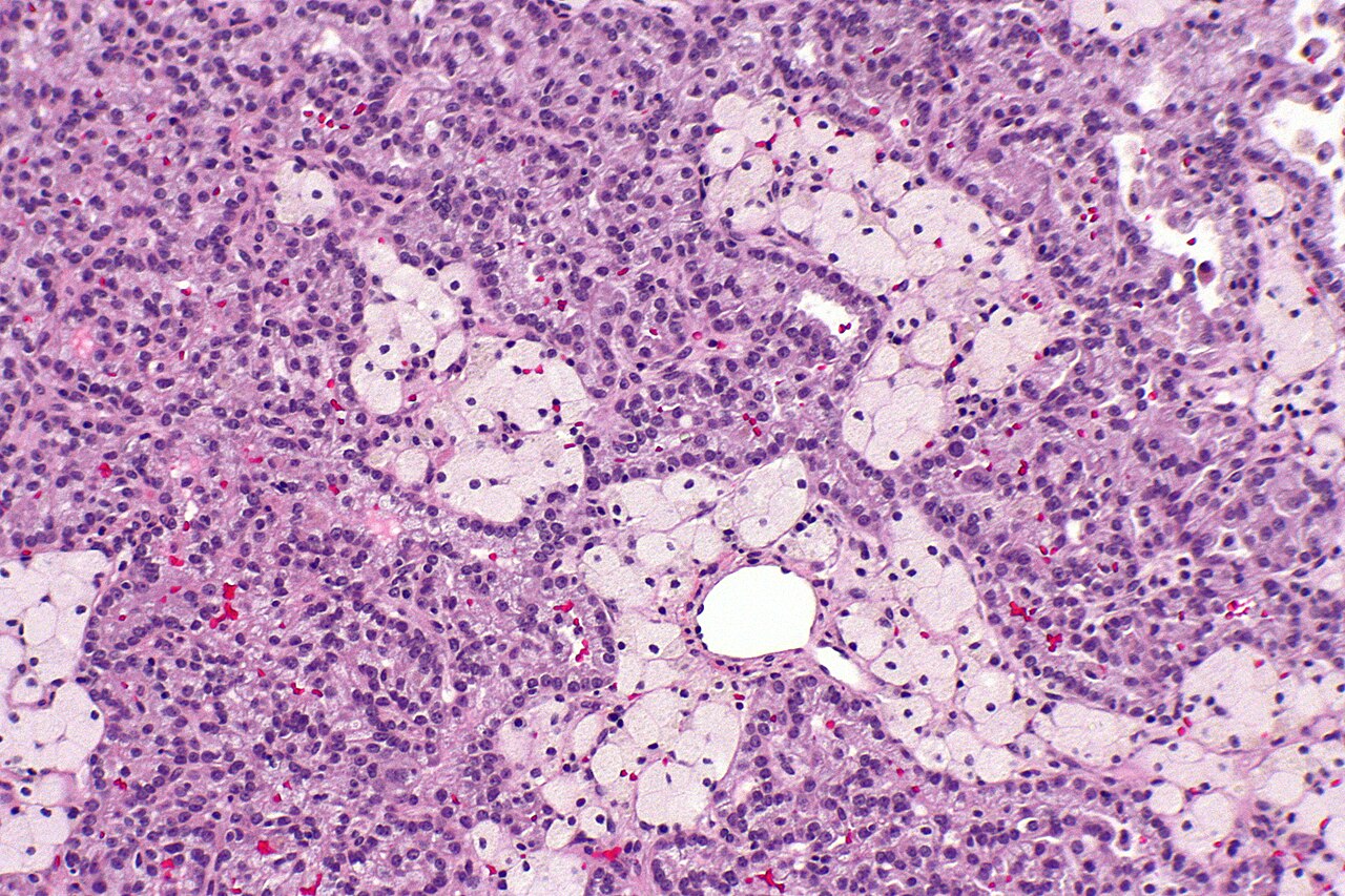 Micrograph of papillary renal cell carcinoma abbreviated par