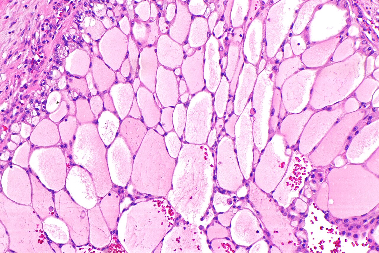 Micrograph of an unclassified renal cell carcinoma abbreviat