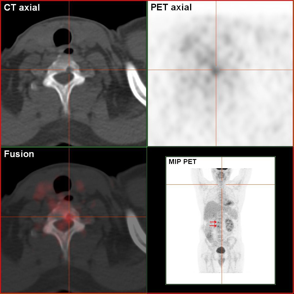 Fdg pet ct scan of patient shown in image renalcancer 700mbq