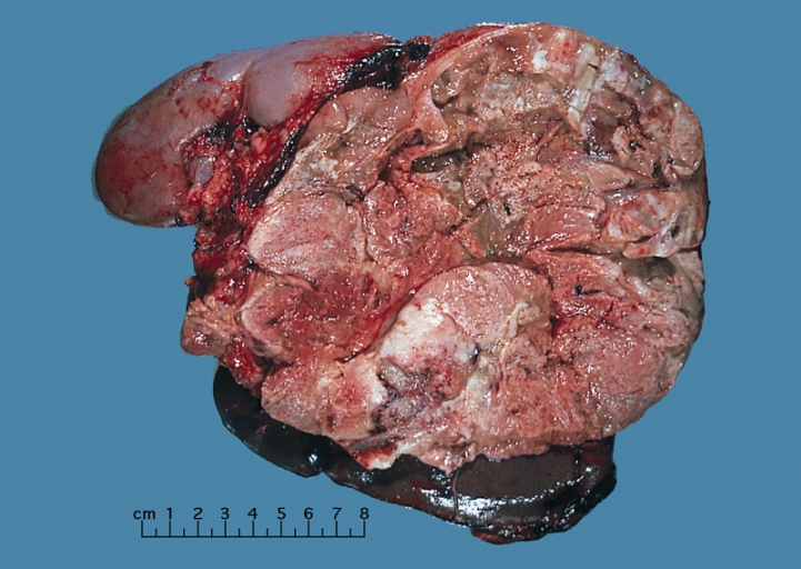 Adrenal gland large adrenal cortical carcinoma this large ad