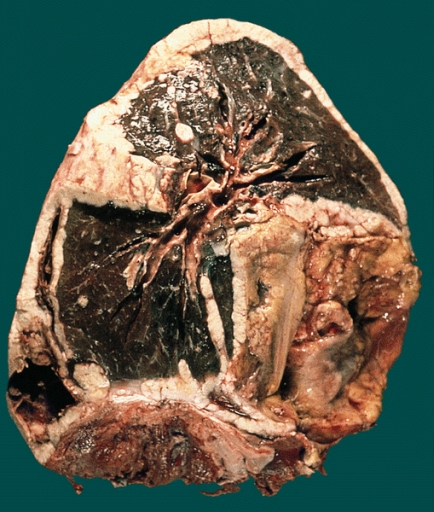 Lower respiratory tract diffuse pleural metastasis simulatin