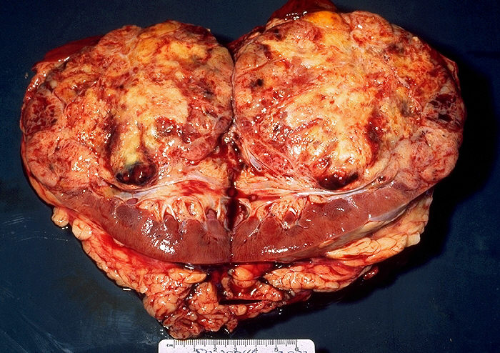 Id 863 description gross pathology of bisected kidney showin