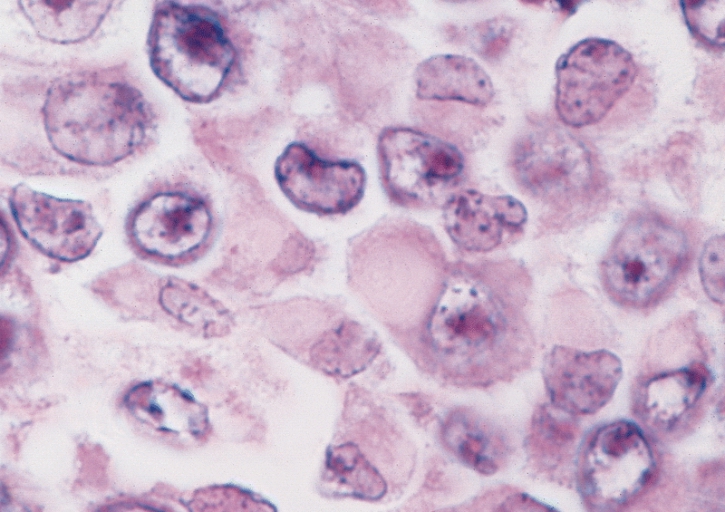Kidney bladder urinary rhabdoid tumor characteristic appeara