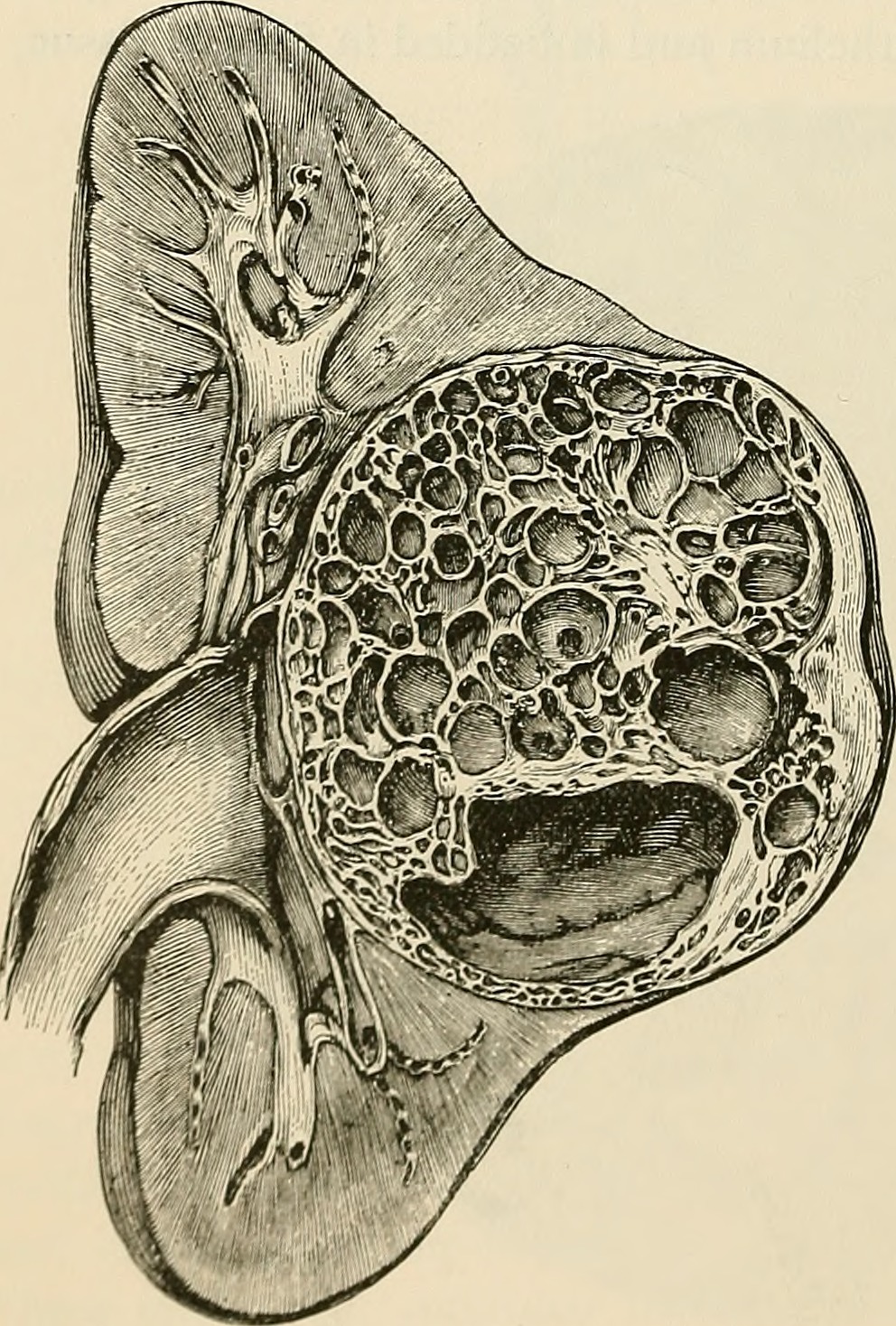 Fig 91 adenoma of the kidney after edmunds identifier pathol