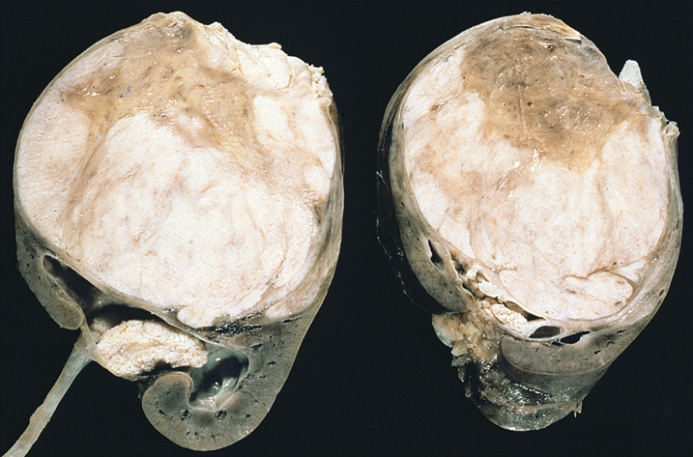 Kidney bladder urinary nephroblastoma note the prominent sep