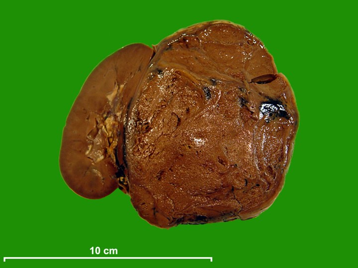 Nephroblastoma human