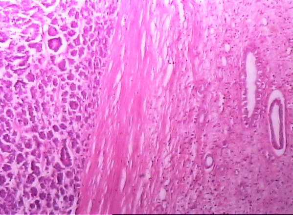 Triphasic pattern showing tubules solid sheets of cells and