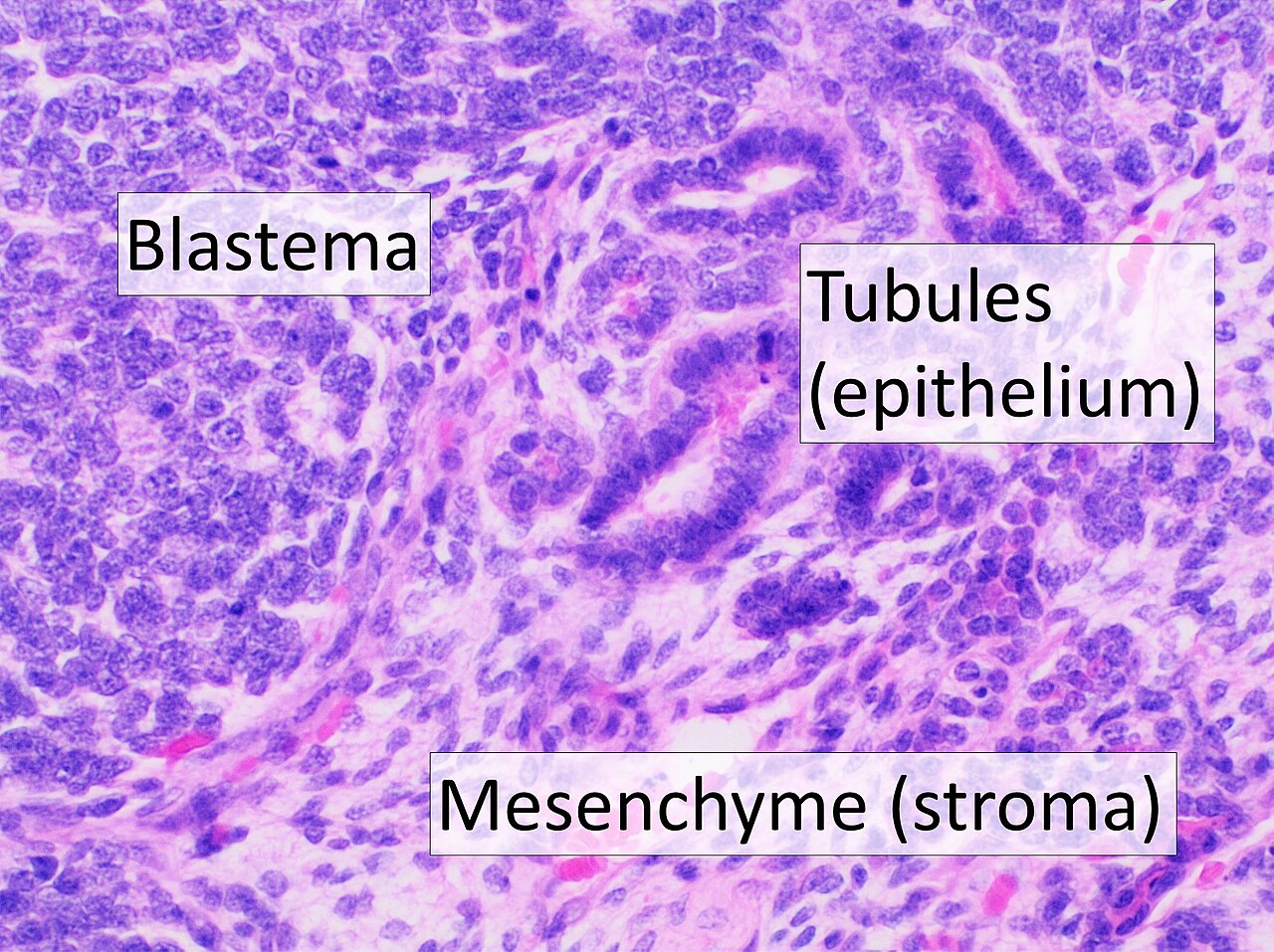 Histopathology of wilms tumor showing its three elements bla