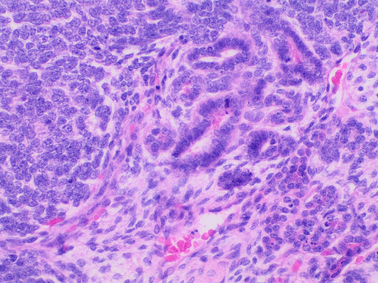 Histopathology of wilms tumor tumor showing its three elemen