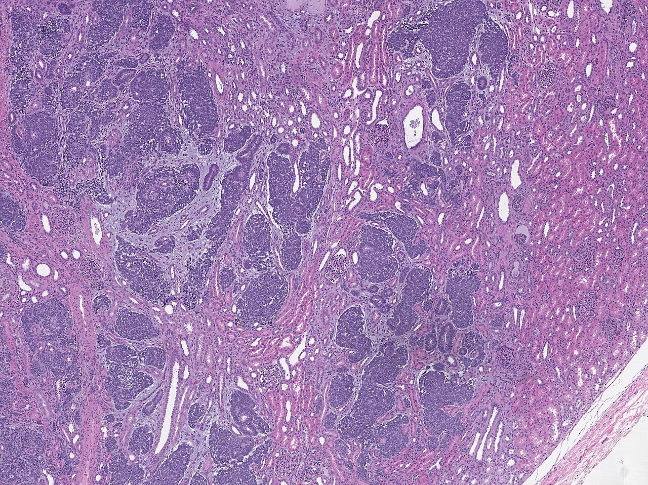 Low magnification micrograph of a wilms tumour infiltrating