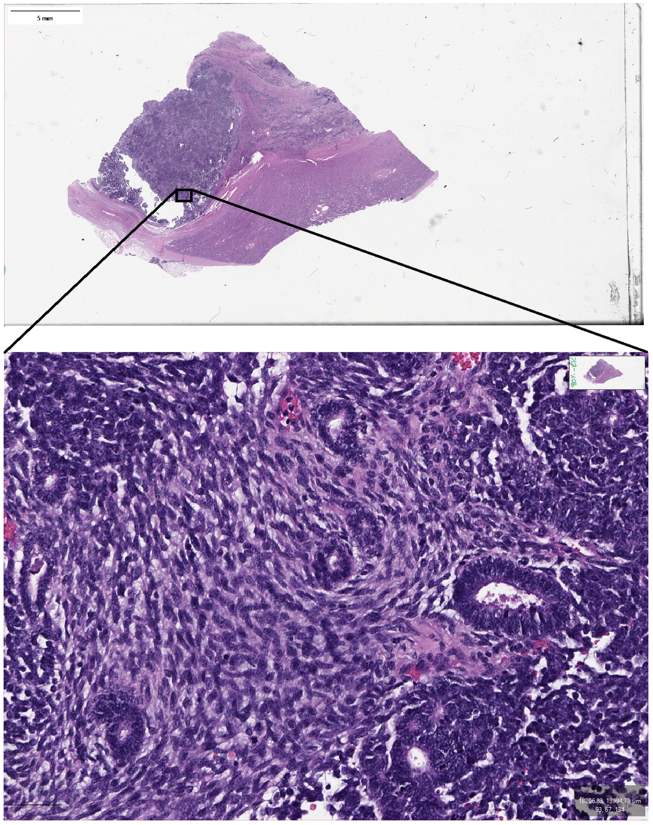Whole slide image of wilms tumor h amp e stain the whole sli