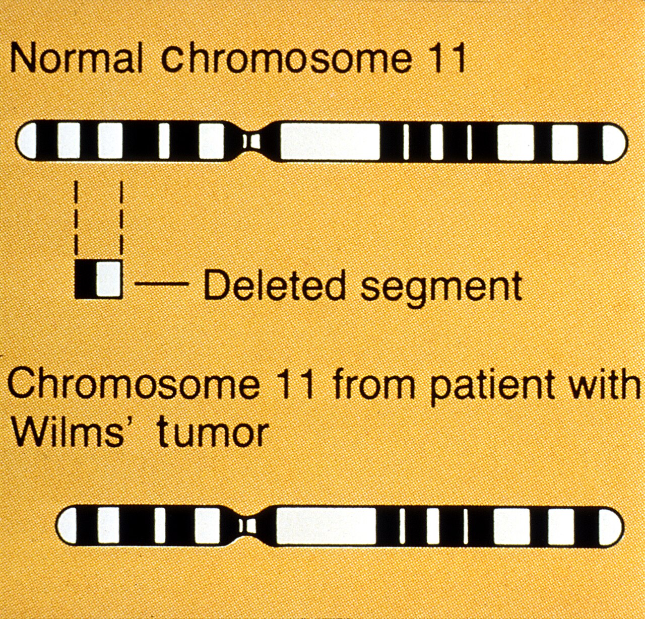 Title wilms tumor illustration description an illustration c