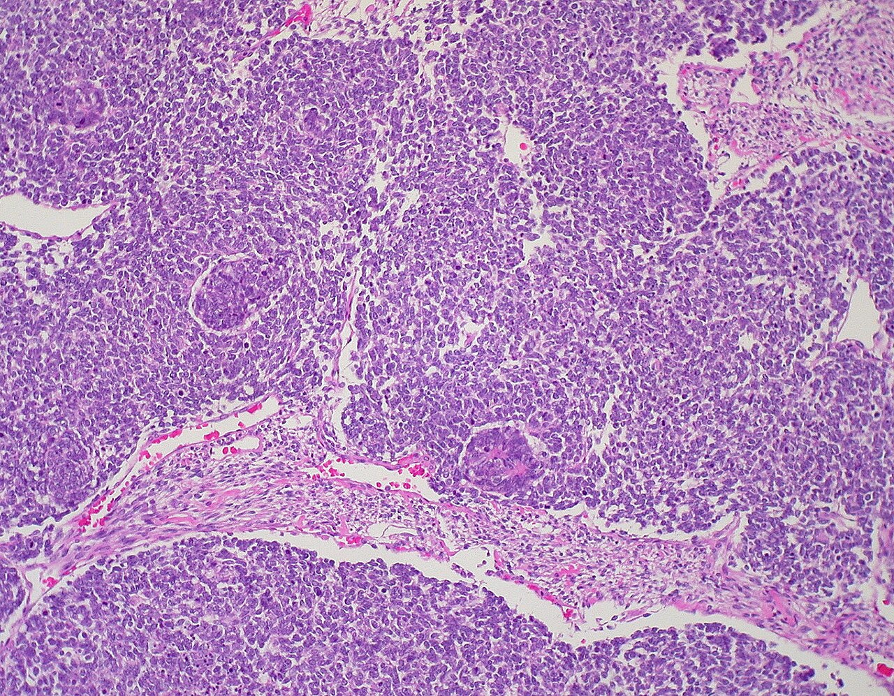 Wilm s tumor nephroblastoma pathological and histological im
