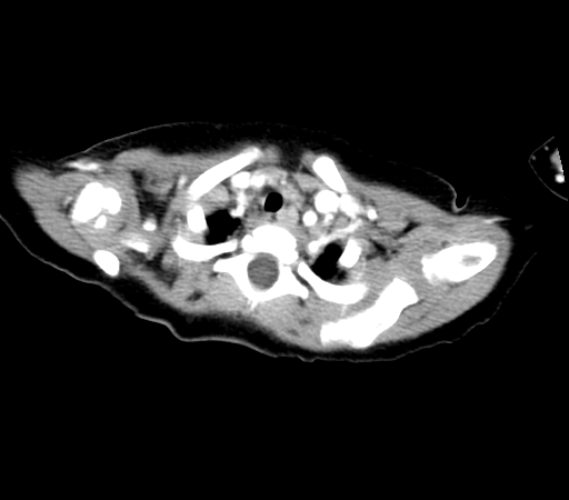 Ct scan of 11 cm wilms tumor nephroblastoma of right kidney