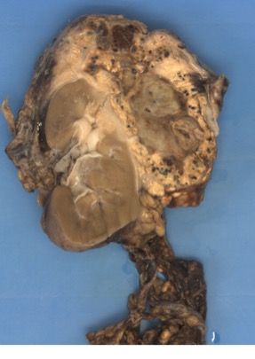 A tumor is seen in the upper pole of the kidney the tumor is