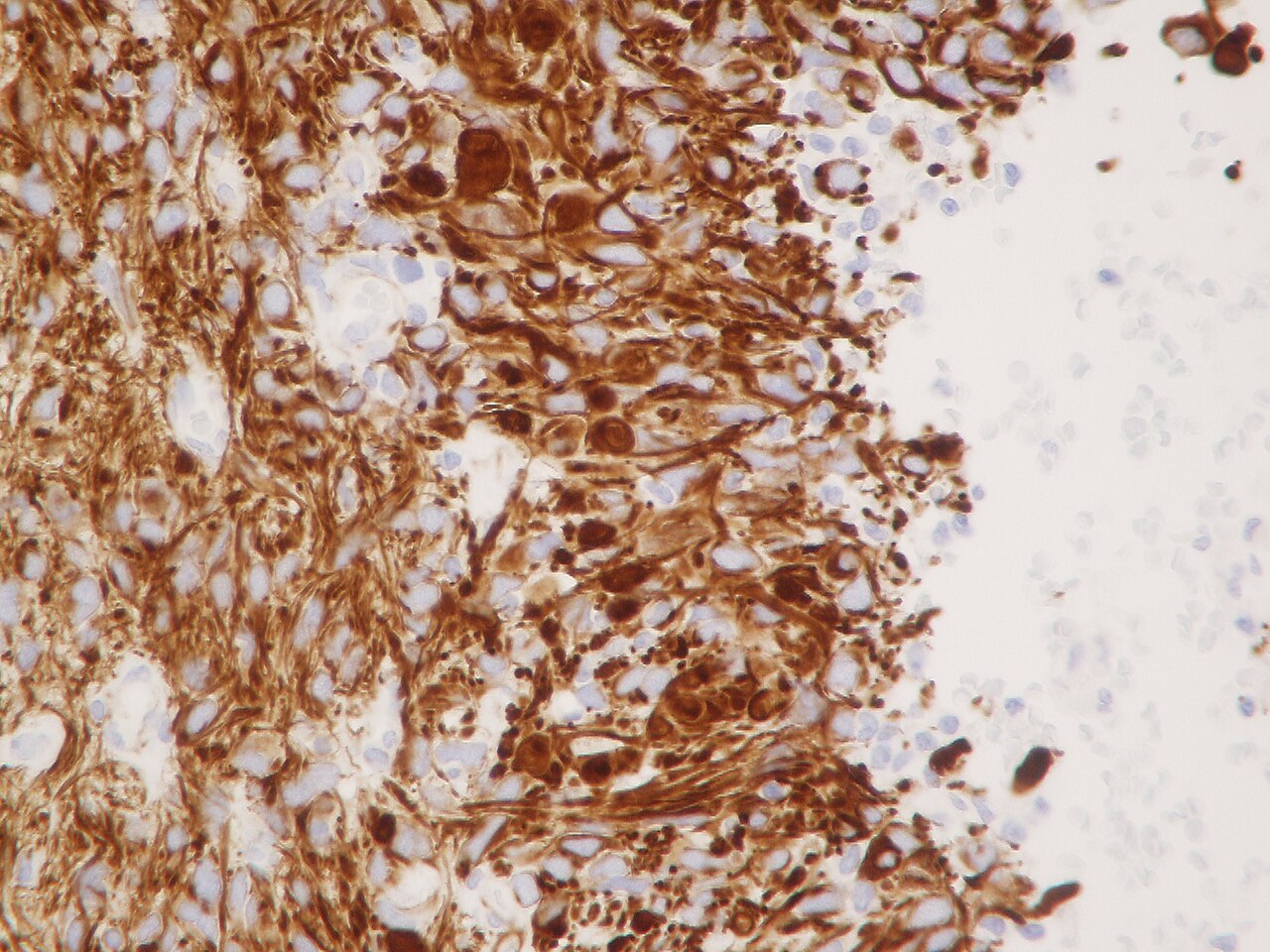 Wt 1 immunohistochemistry cytoplasmatic staining in glioblas