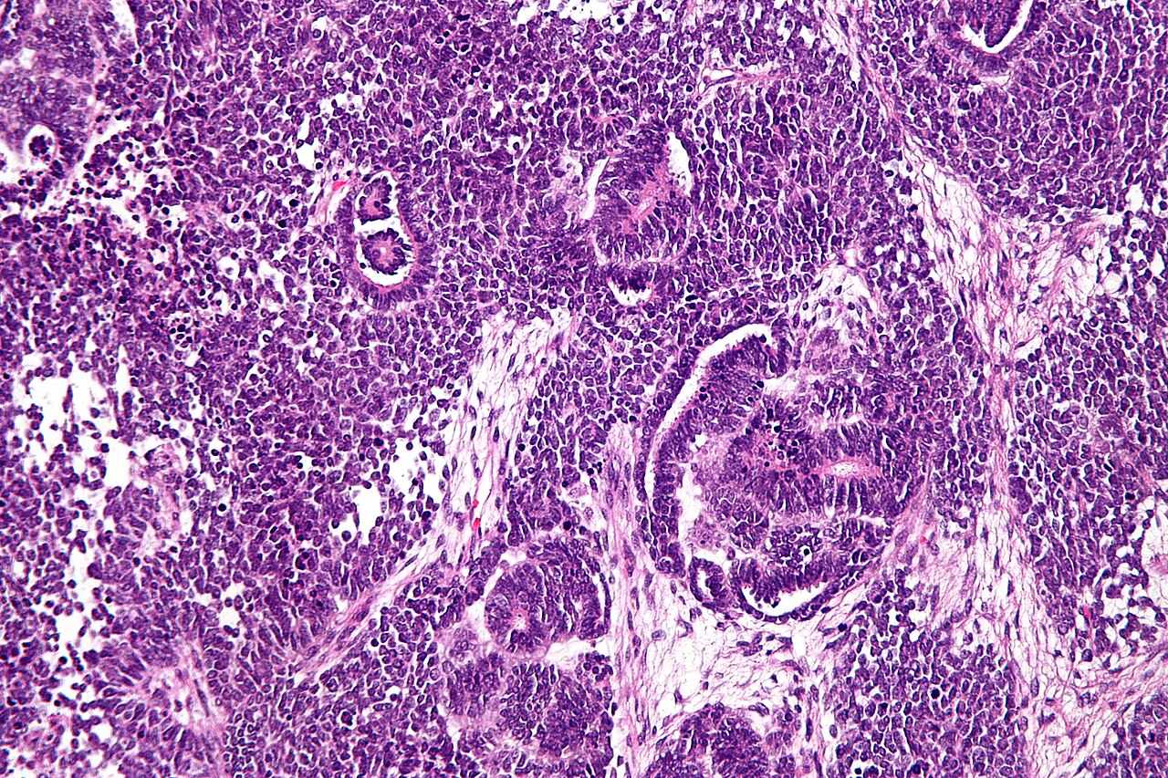 High magnification micrograph of a wilms tumour also nephrob
