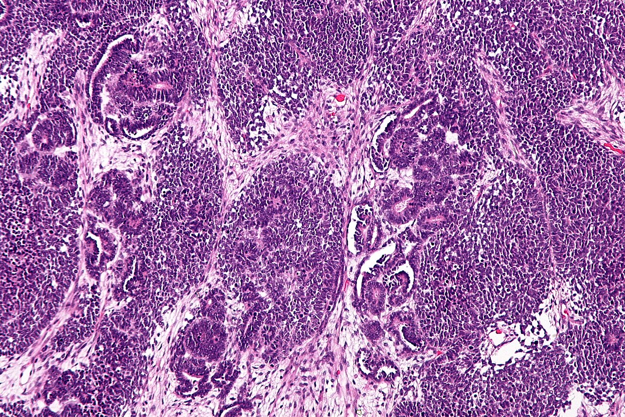 Intermediate magnification micrograph of a wilms tumour also