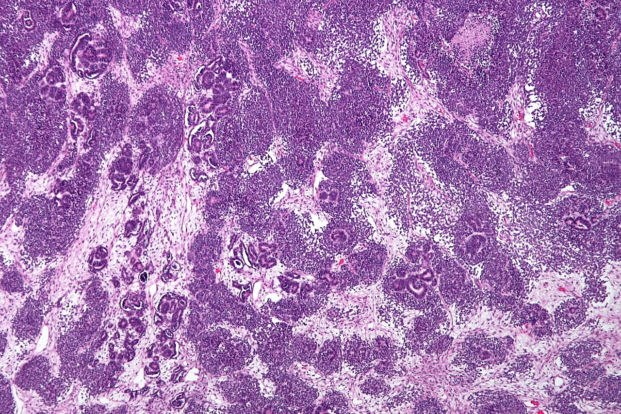 Low magnification micrograph of a wilms tumour also nephrobl