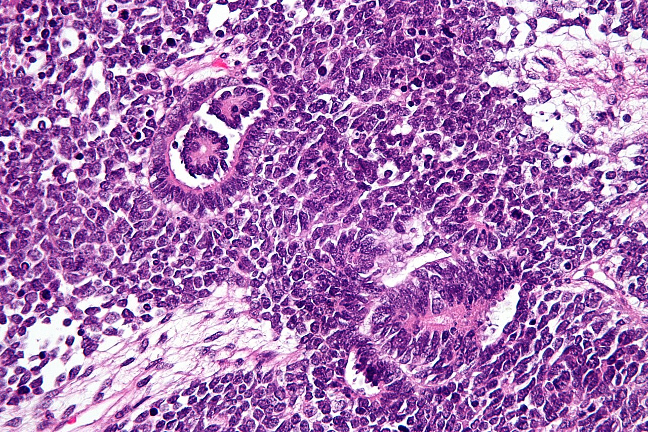 Very high magnification micrograph of a wilms tumour also ne