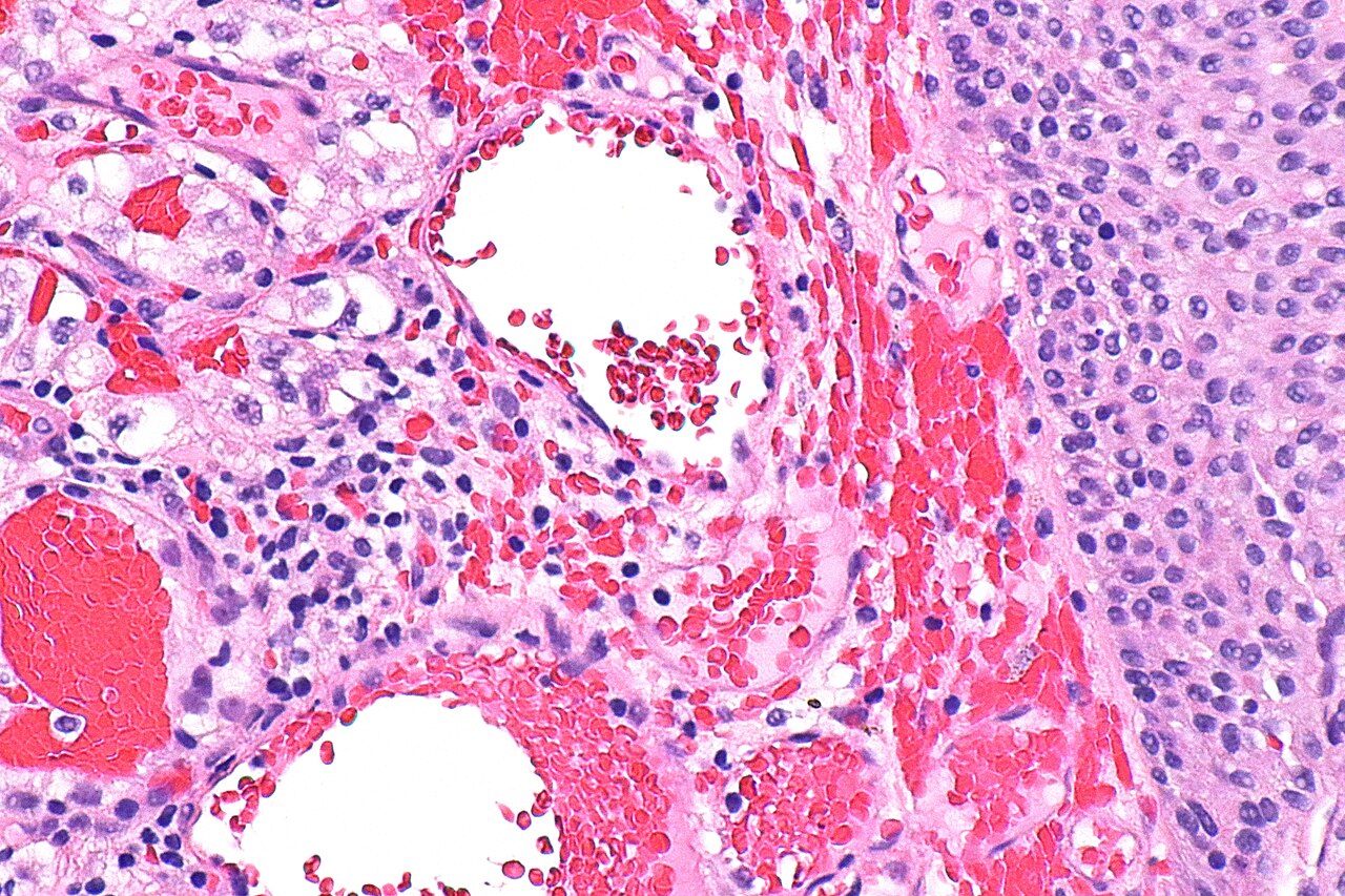 Micrograph showing metastatic clear cell renal cell carcinom