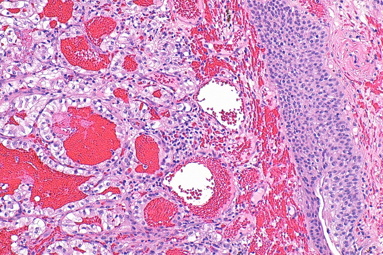 Micrograph showing metastatic clear cell renal cell carcinom