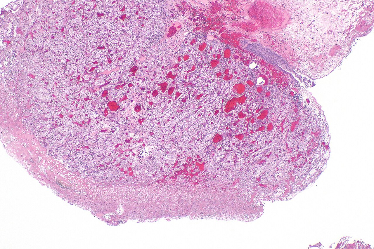 Micrograph showing metastatic clear cell renal cell carcinom
