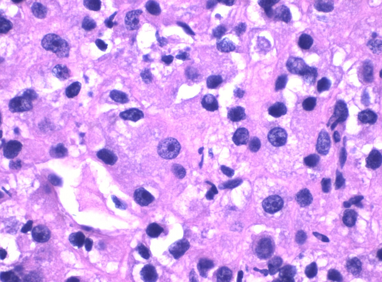 Histopathology of grade 3 clear cell renal cell carcinoma di