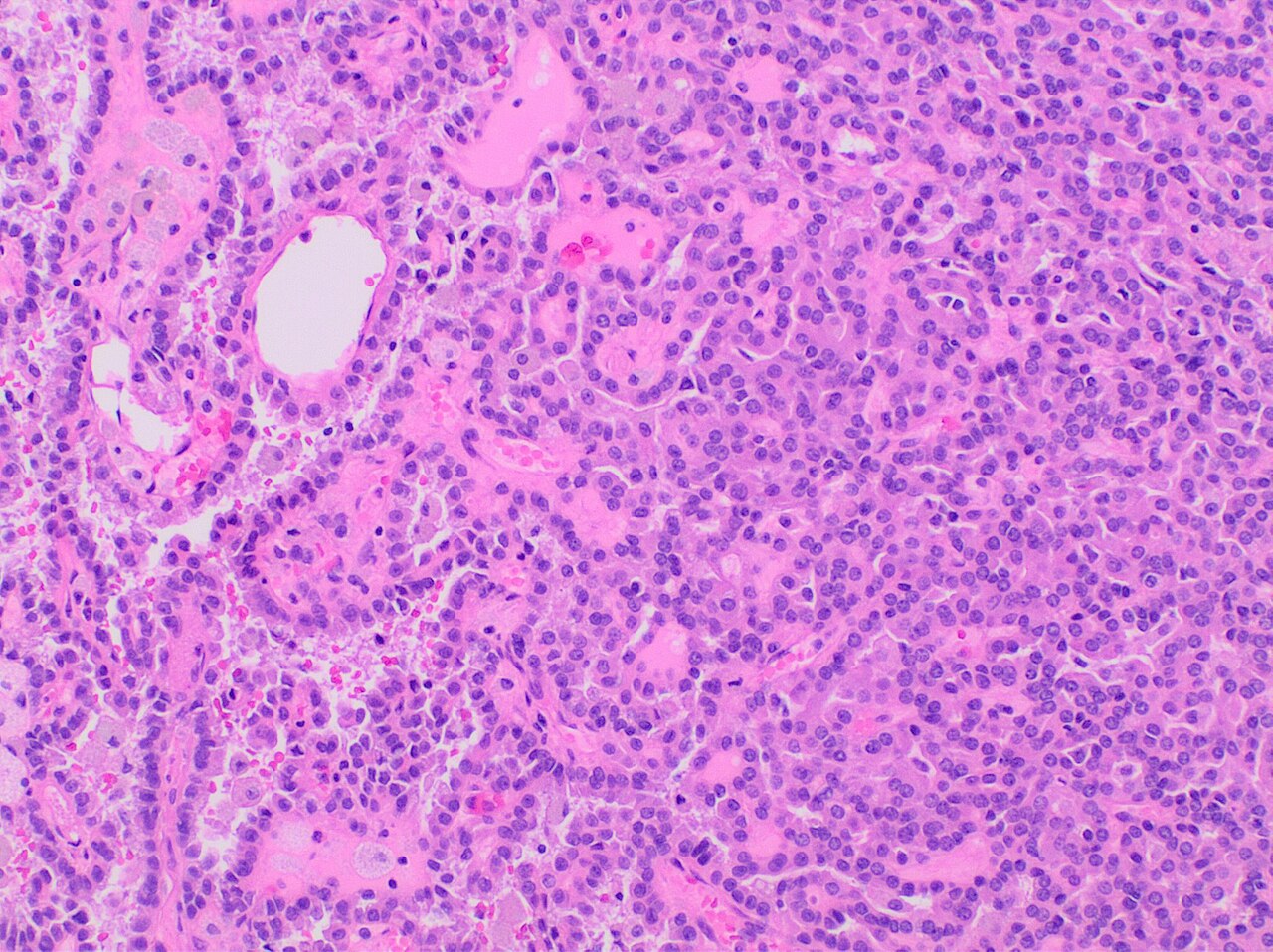 Histopathology of papillary renal cell carcinoma type 1 grad