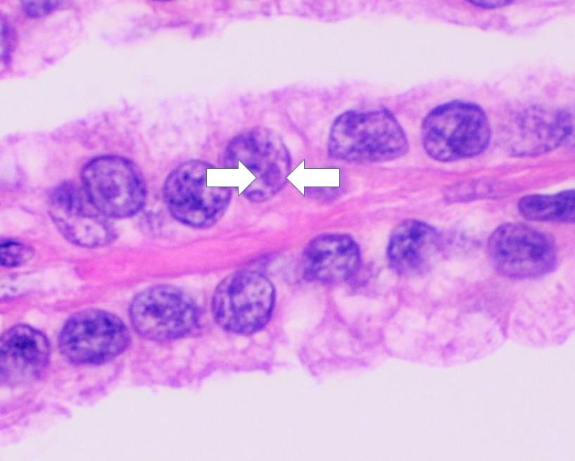 Histopathology of papillary renal cell carcinoma type 1 grad