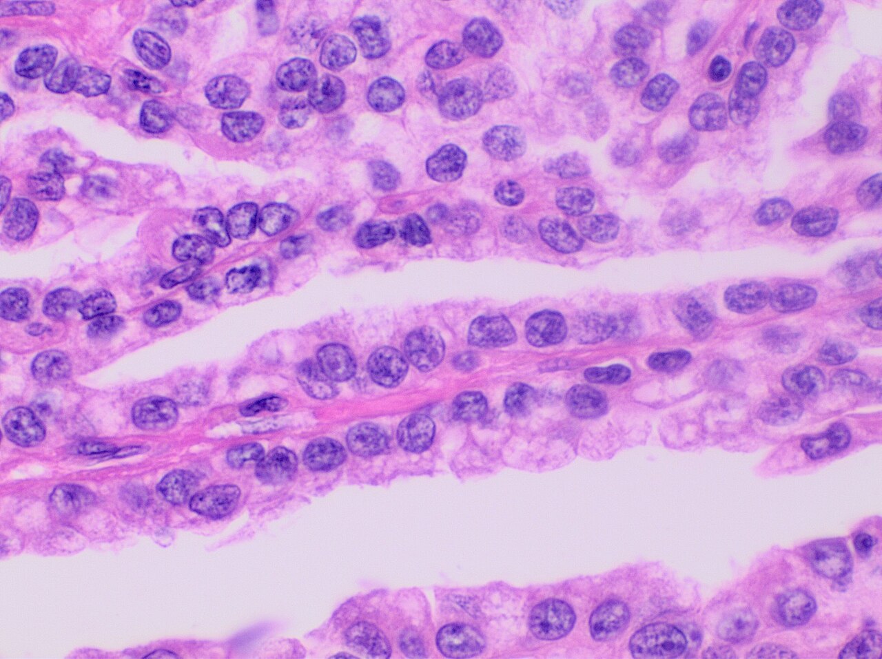 Histopathology of papillary renal cell carcinoma type 1 grad