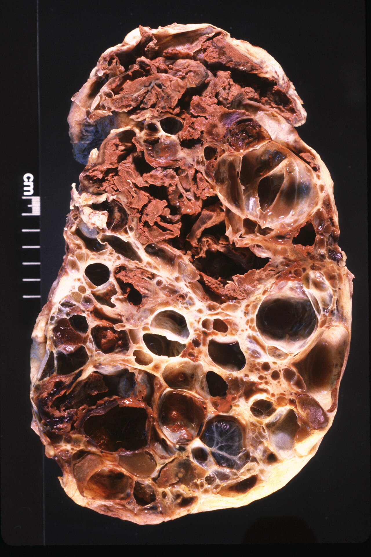 Adult polycystic kidney from a bilateral nephrectomy specime