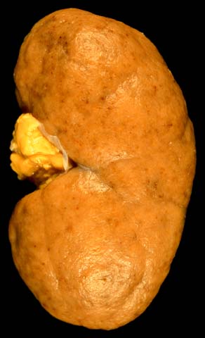 Diffuse proliferative lupus nephritis this photo of type iv